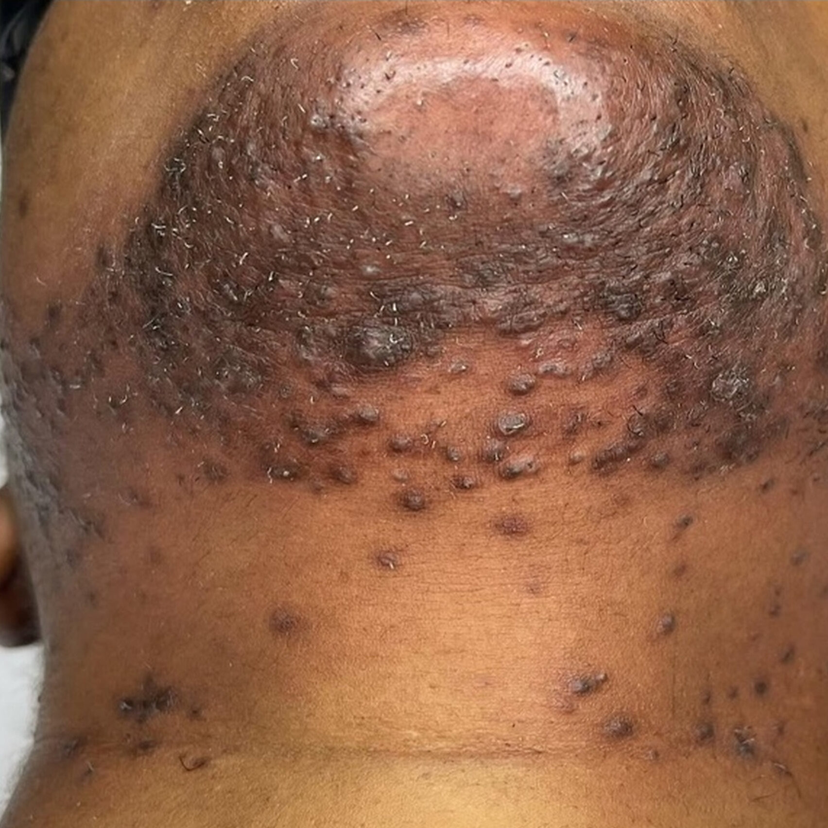 Before laserontharen hirsutisme en PIH vrouw