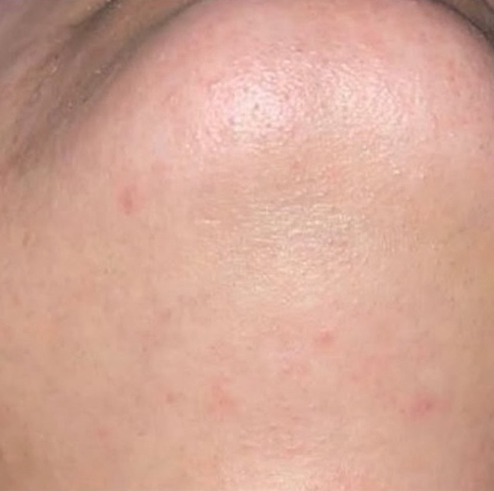 After laserontharen hirsutisme vrouw