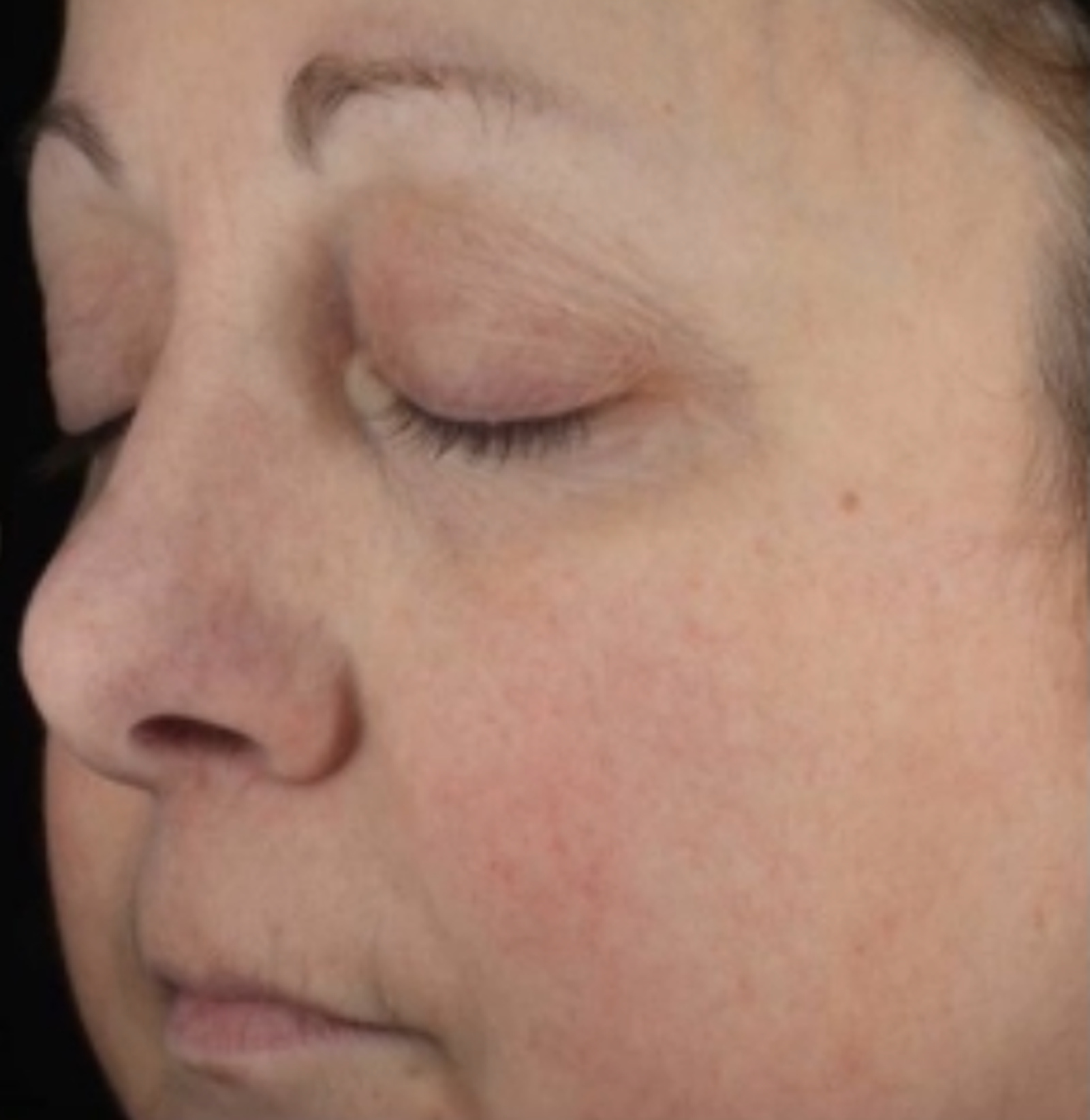 After roodheid rosacea